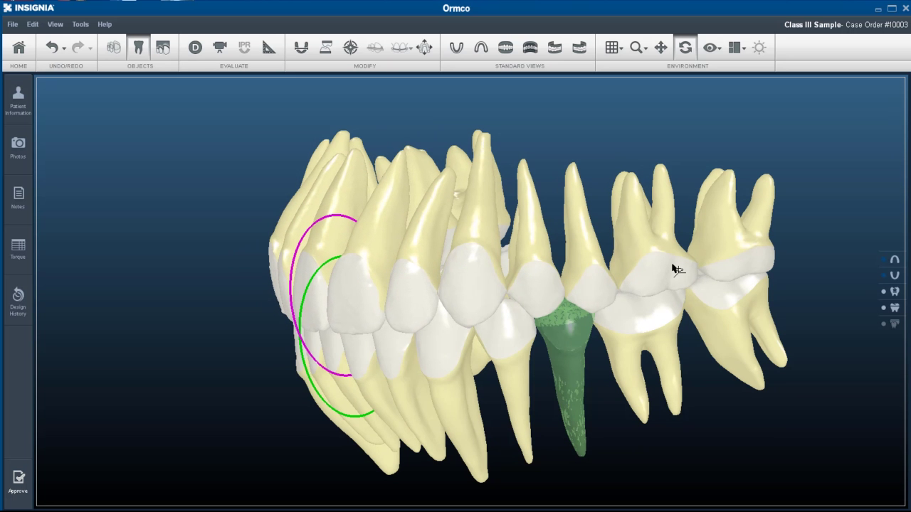 Anterior Torque